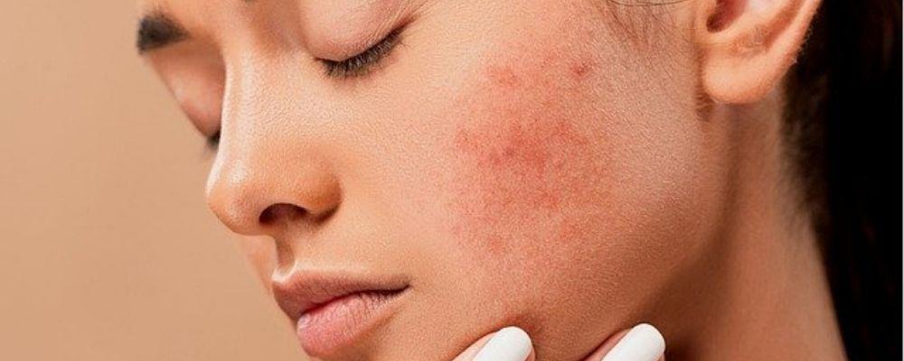 How to prevent acne from whey protein